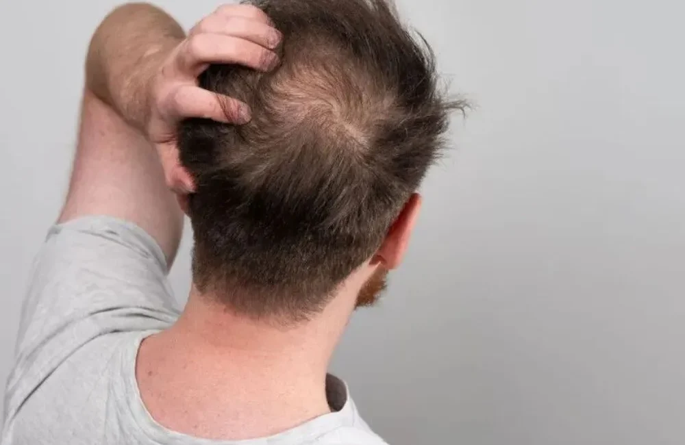 Evitar a Queda de Cabelo Apenas Mudando a Alimentação