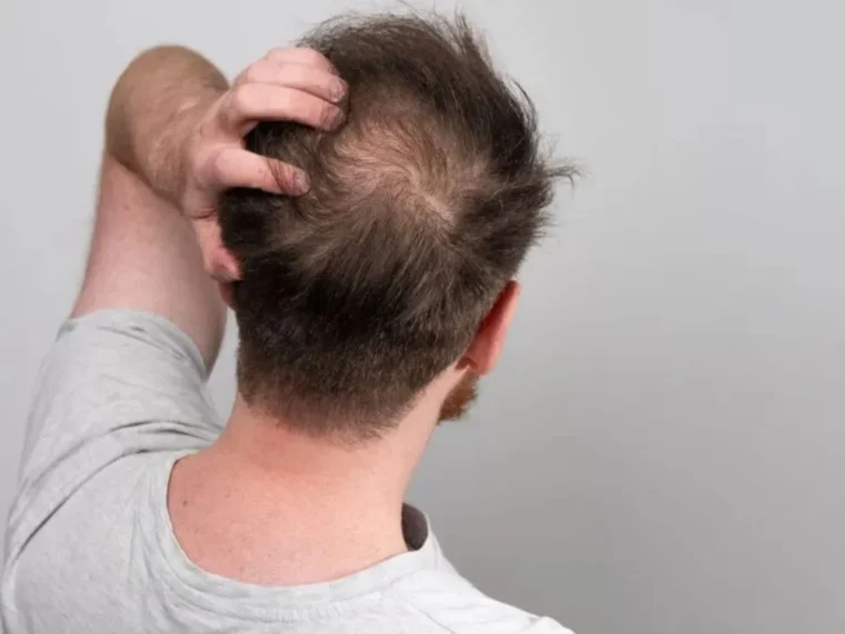 Evitar a Queda de Cabelo Apenas Mudando a Alimentação